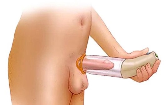 Bateriová vakuová pumpa na penis pro erektilní dysfunkci a lepší erekci